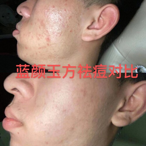 祛痘案例