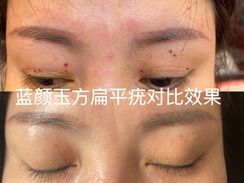扁平疣案例