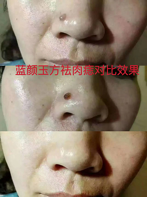 祛痣案例